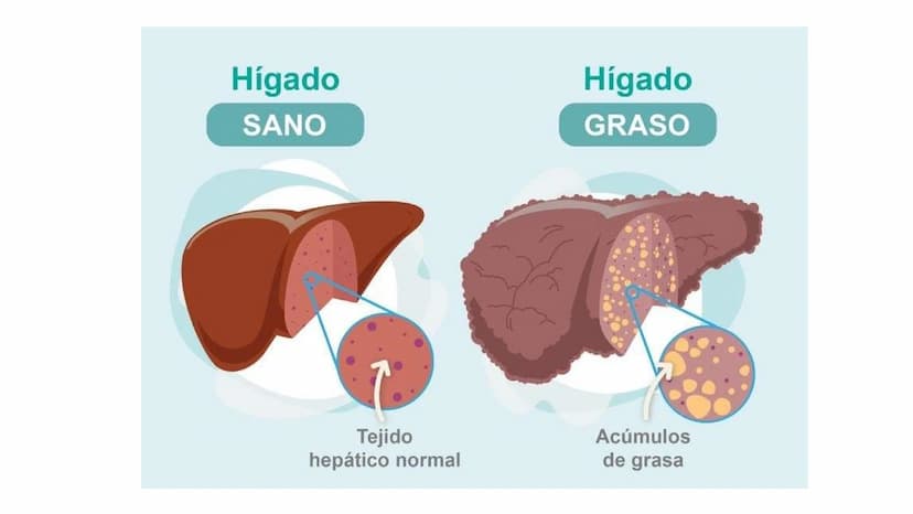 FISIOLOGIA
HIGADO
COMO GLANDULA DEFINCION
El hígado (hepar) es una glándula
anexa del sistema que vierte bilis,
producto de su secreción ext