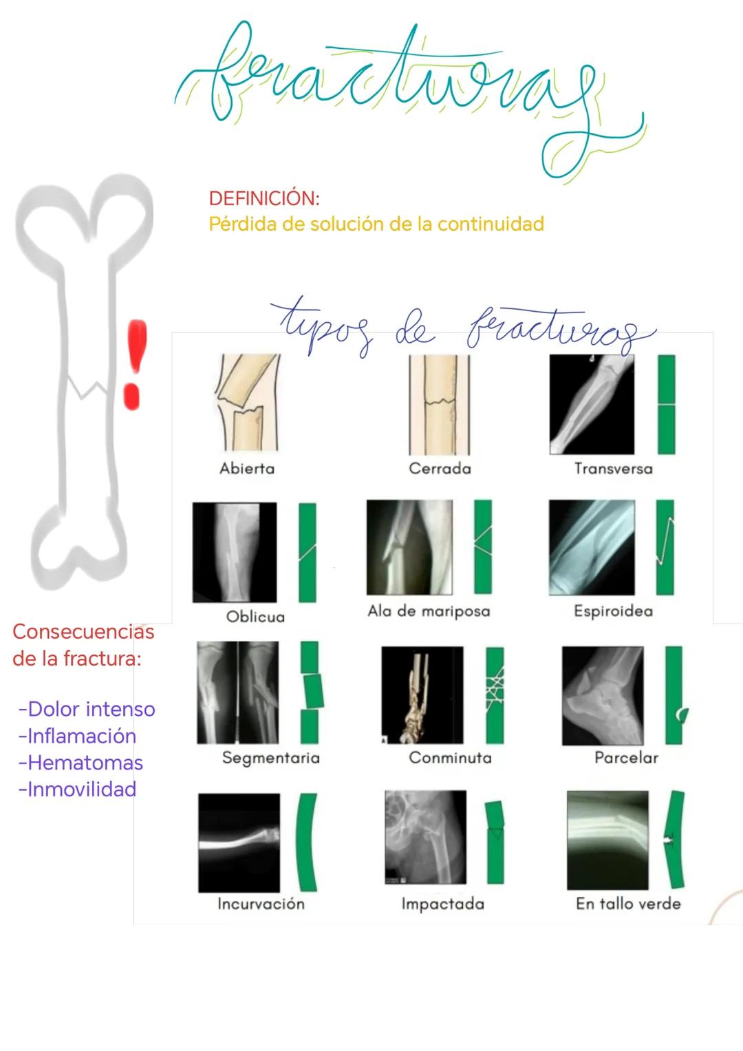 hueso
epifisis
Metáfisis
Periosito fis
Metáfisis
Endostio
Diáfisis
Epifisis
Funciones de los huesos:
Moverse
Soporte
Producción de cé