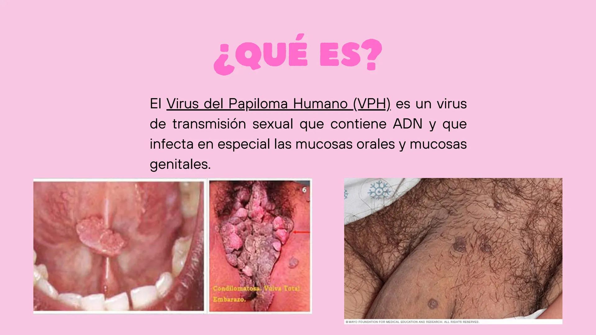 VPH
VIRUS DEL
PAPILOMA
HUMANO
☐ ¿QUÉ ES?
El Virus del Papiloma Humano (VPH) es un virus
de transmisión sexual que contiene ADN y que
infecta