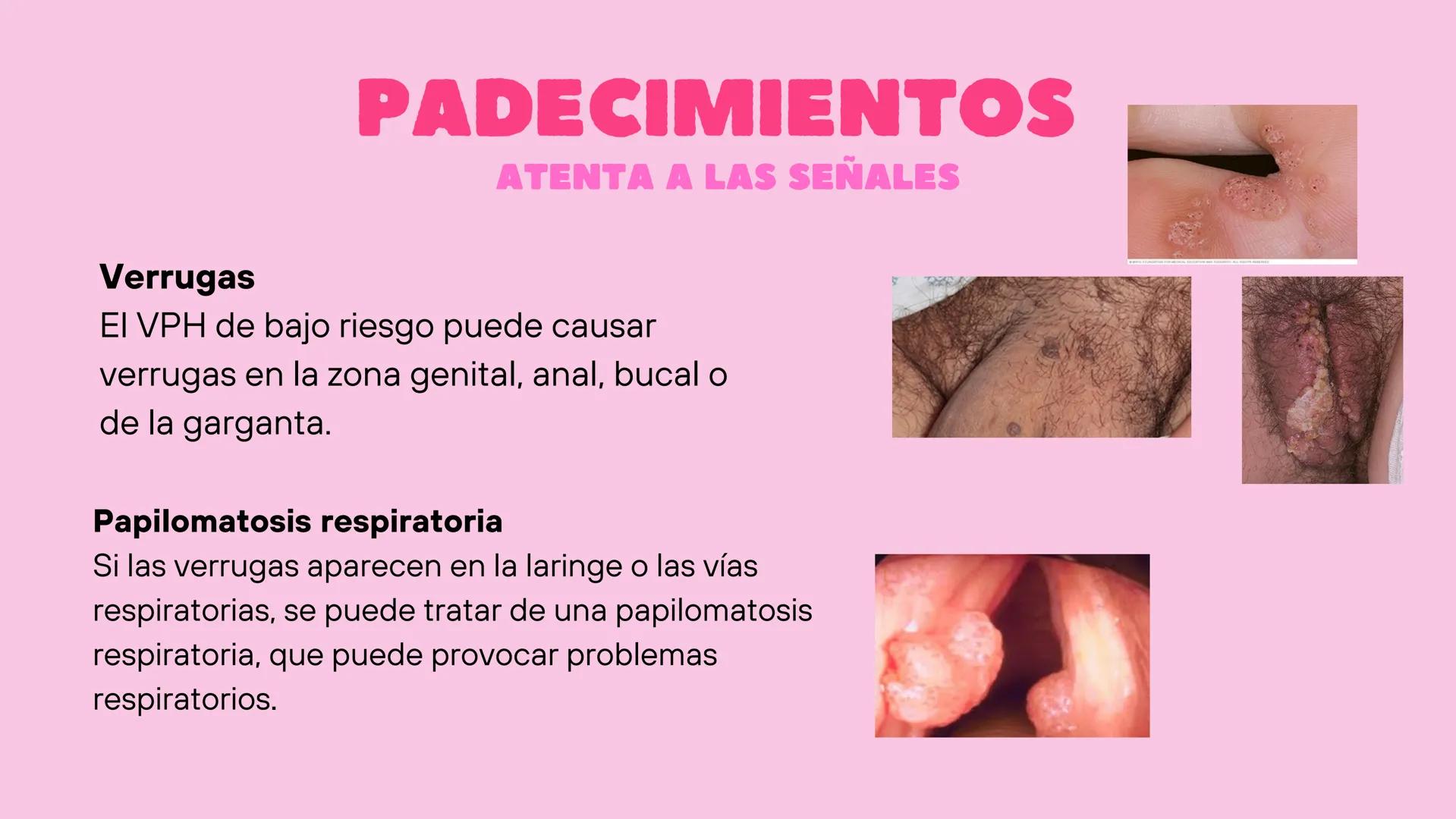 VPH
VIRUS DEL
PAPILOMA
HUMANO
☐ ¿QUÉ ES?
El Virus del Papiloma Humano (VPH) es un virus
de transmisión sexual que contiene ADN y que
infecta