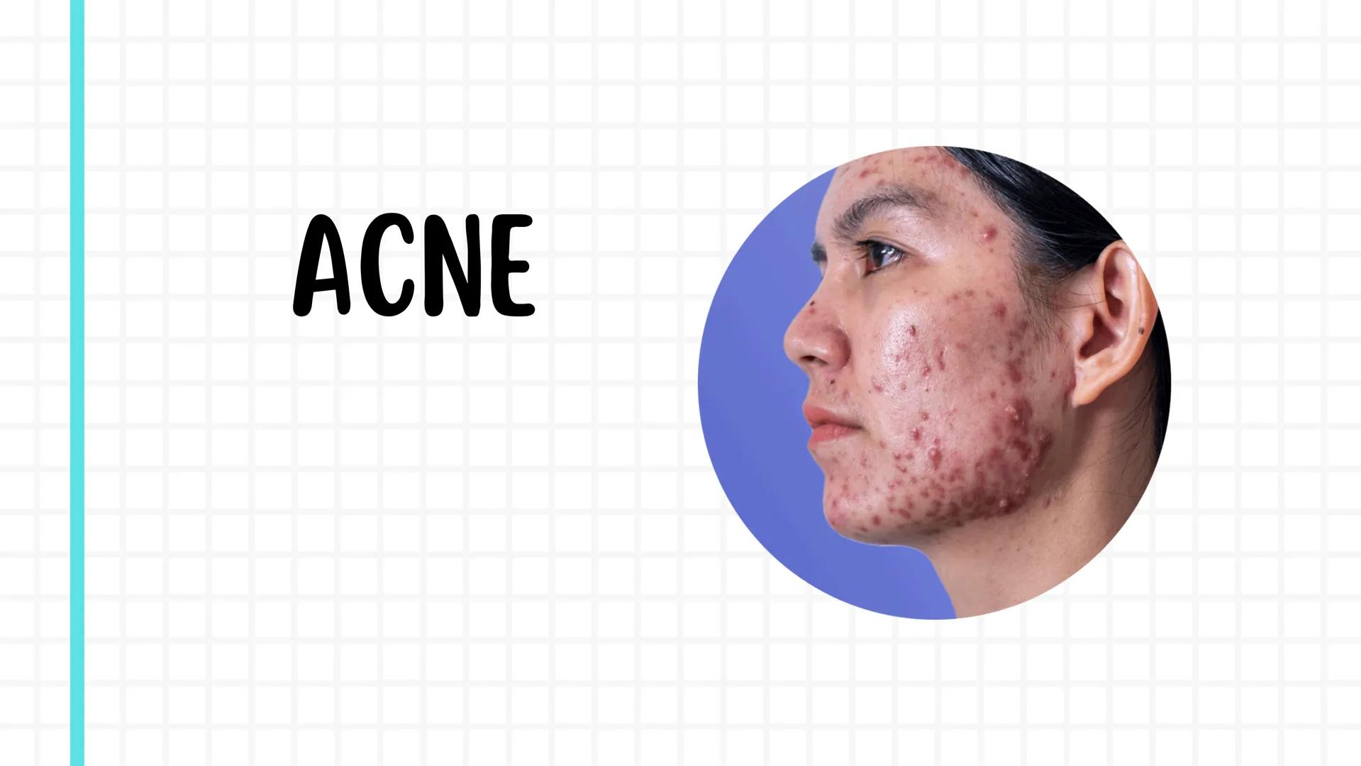 # ACNE # DEFINICION
El acné es una enfermedad
inflamatoria crónica de la piel
que afecta principalmente
a las glándulas sebáceas
* carac