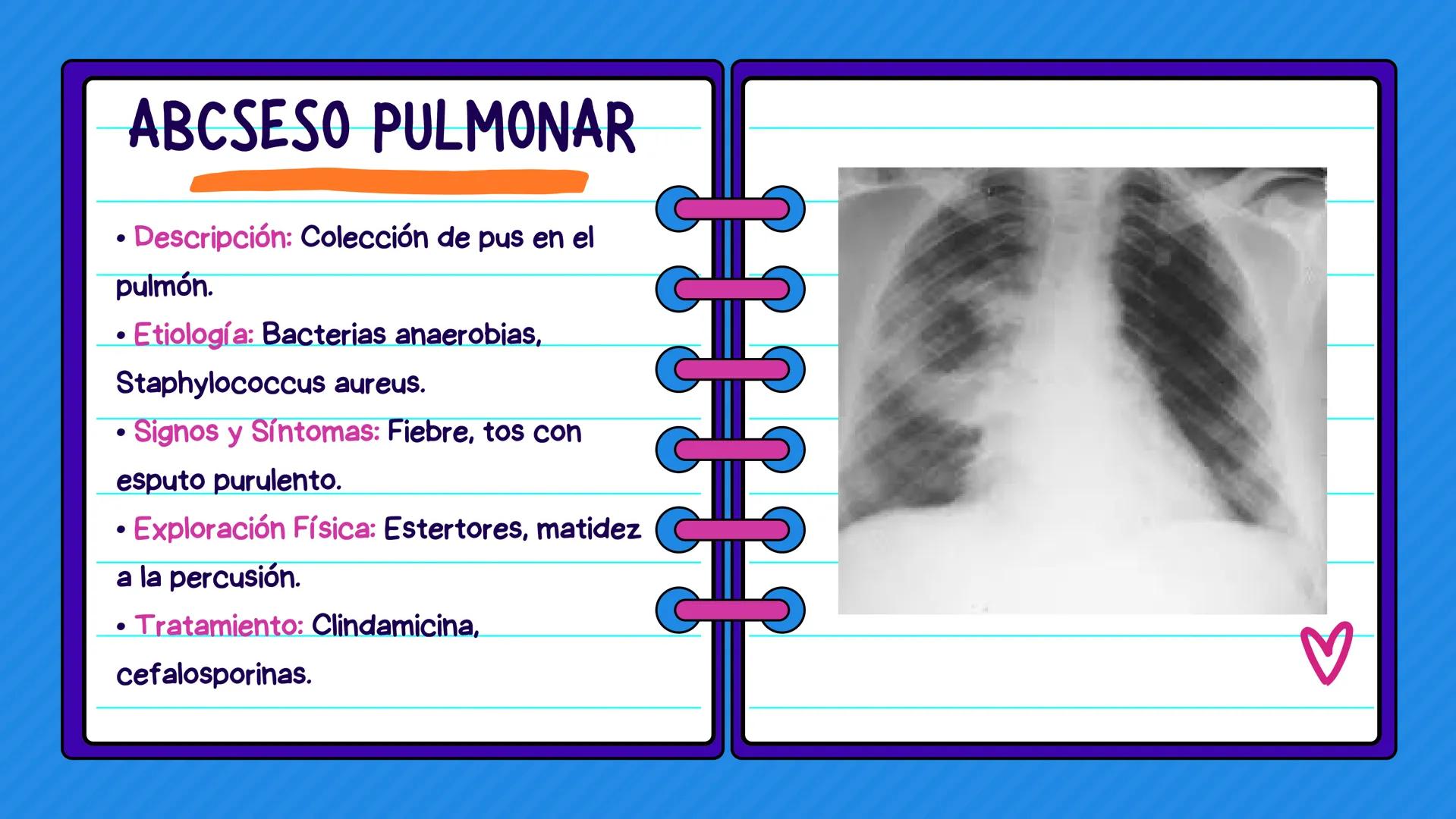 FLASH CARDS INFECCIÓNES DE
VÍAS AÉREAS # Infecciones de vías
aéreas superiores FARINGITIS AGUDA
• Descripción: Inflamación de la faringe.