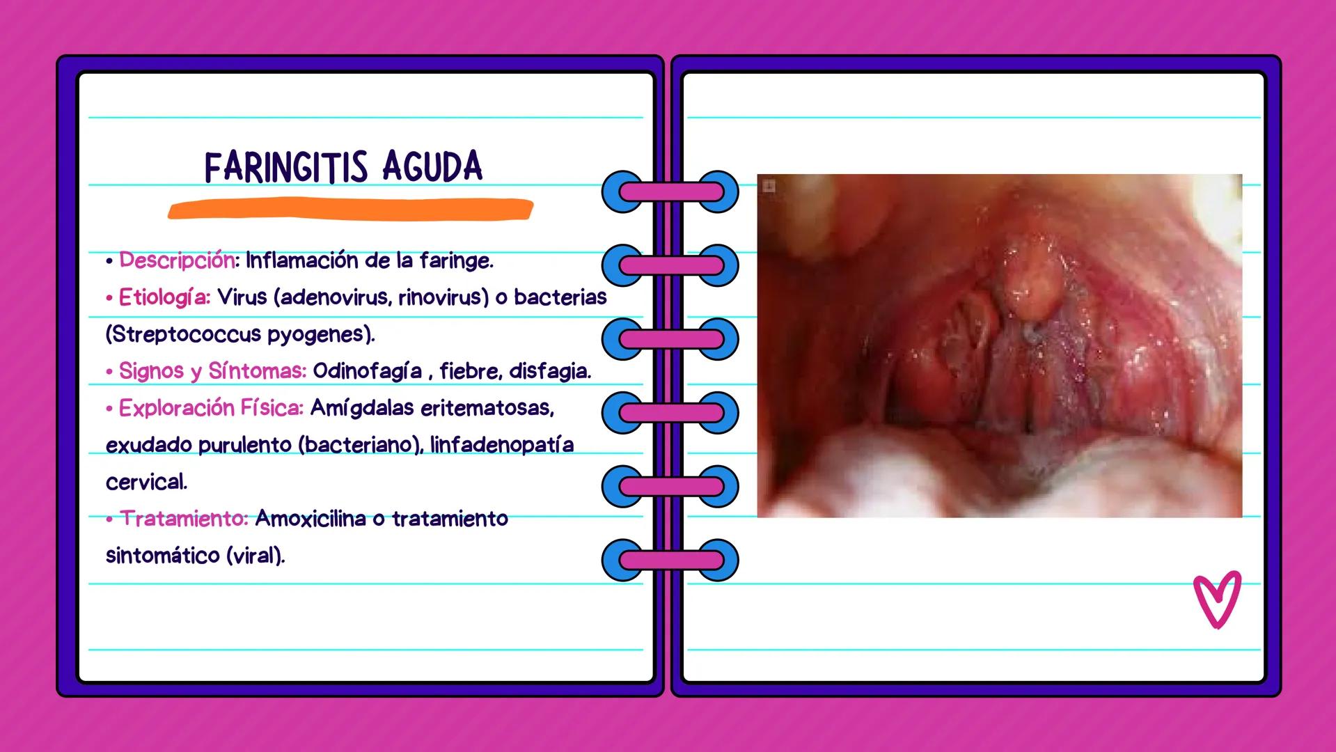 FLASH CARDS INFECCIÓNES DE
VÍAS AÉREAS # Infecciones de vías
aéreas superiores FARINGITIS AGUDA
• Descripción: Inflamación de la faringe.