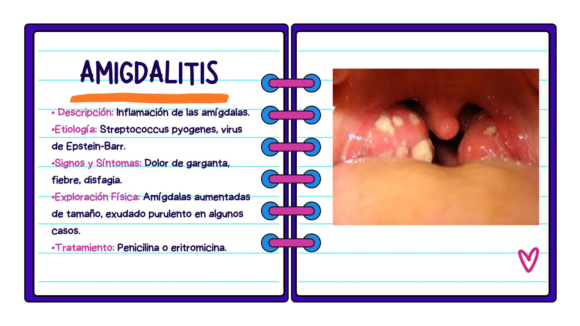 FLASH CARDS INFECCIÓNES DE
VÍAS AÉREAS # Infecciones de vías
aéreas superiores FARINGITIS AGUDA
• Descripción: Inflamación de la faringe.