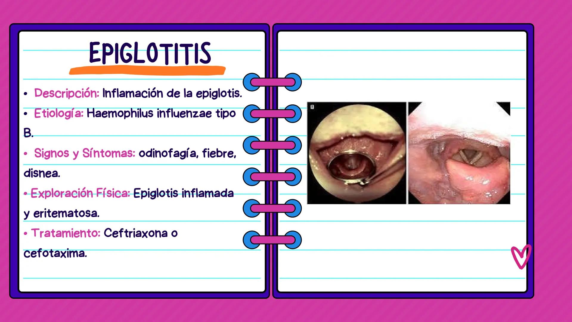 FLASH CARDS INFECCIÓNES DE
VÍAS AÉREAS # Infecciones de vías
aéreas superiores FARINGITIS AGUDA
• Descripción: Inflamación de la faringe.