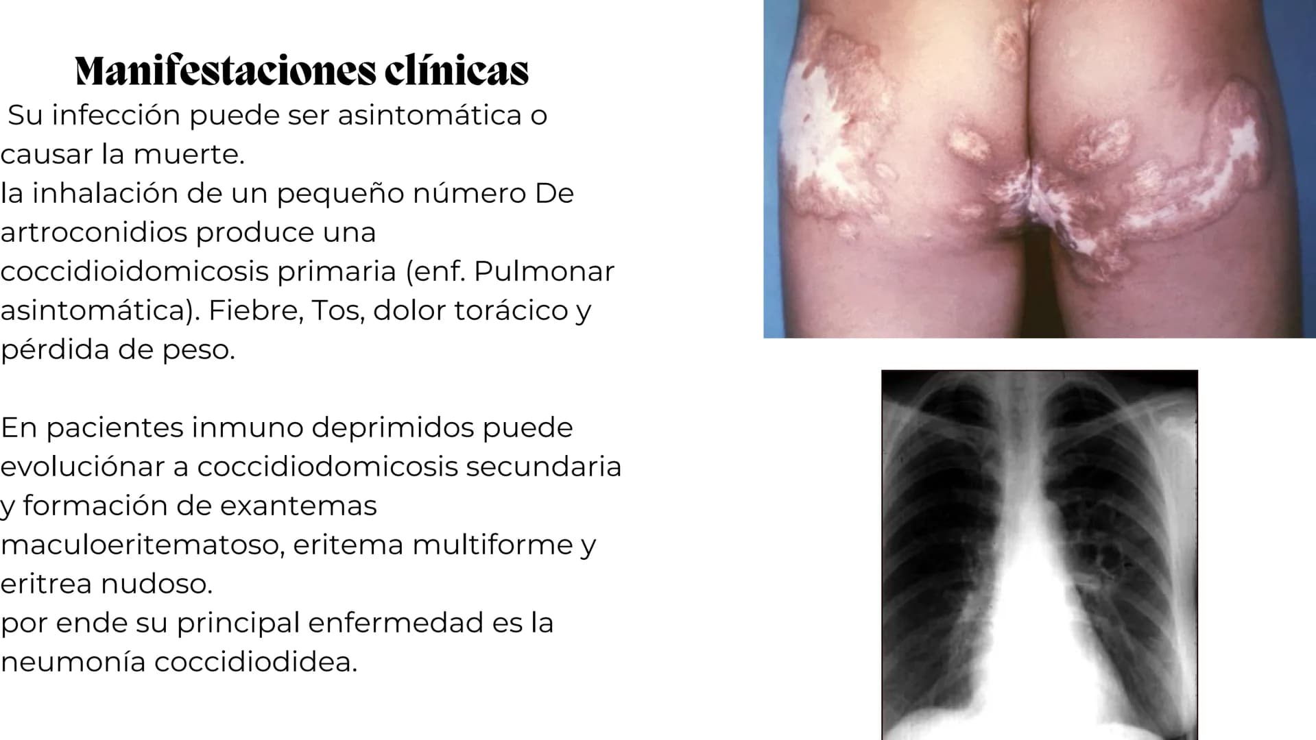 UNIVERSIDAD
POTOSINA
# Micosis Sistemáticas
Causadas por hongos dimórficos
Por Alejandro Cortez Y Julio
Meléndez Nava
Octubre 2024 # Hong