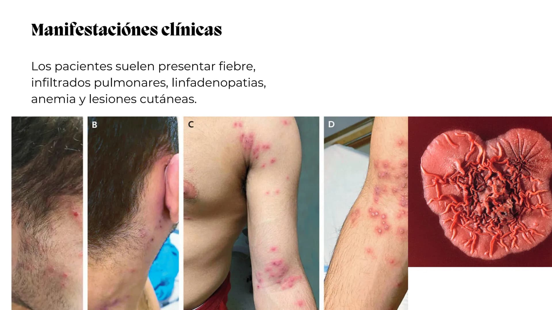 UNIVERSIDAD
POTOSINA
# Micosis Sistemáticas
Causadas por hongos dimórficos
Por Alejandro Cortez Y Julio
Meléndez Nava
Octubre 2024 # Hong