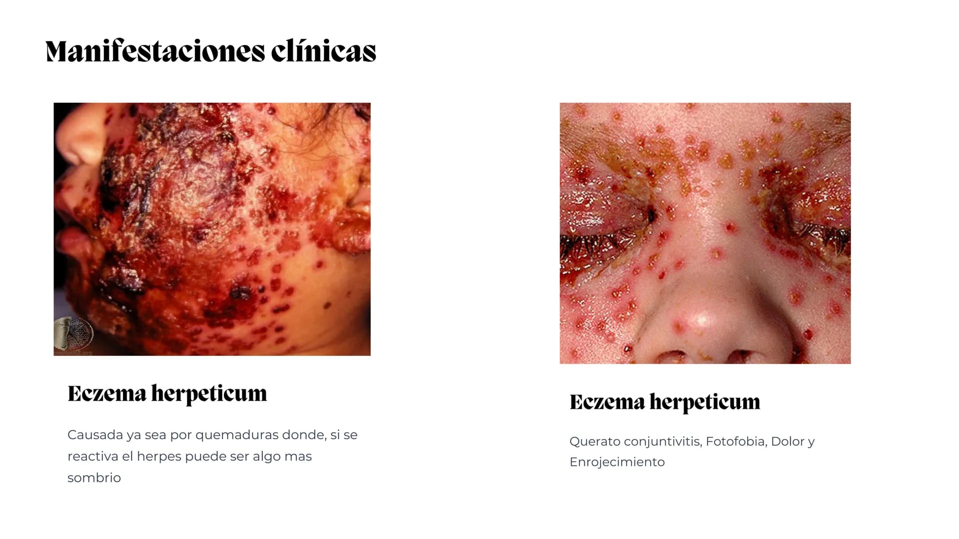 UNIVERSIDAD
POTOSINA
# Virus del herpes
Patogenia, transmision y manifestaciones
clínicas del herpes
Por Alejandro Cortez y
Julio Melénde