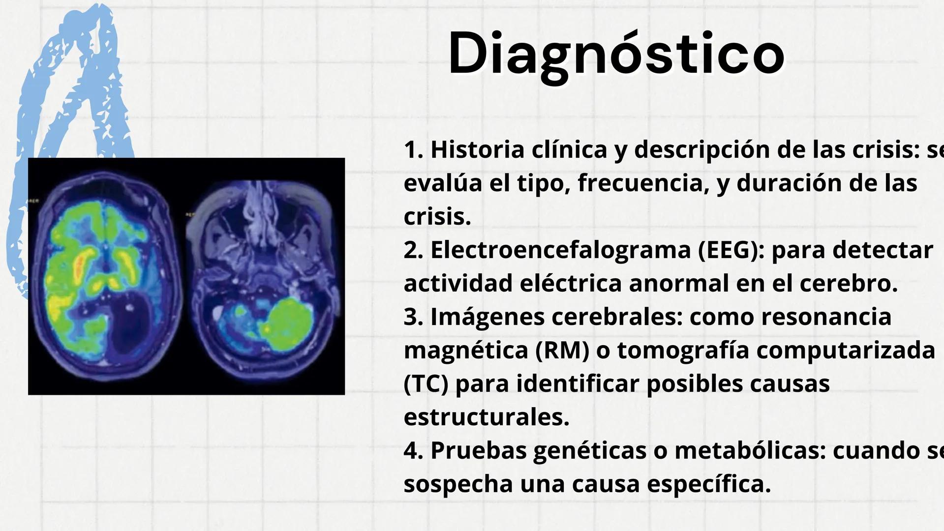 # Epilepsia
Nancy Jocabeth Flores Rosas # Definición
La epilepsia es un trastorno
neurológico caracterizado por la
aparición de crisis epi