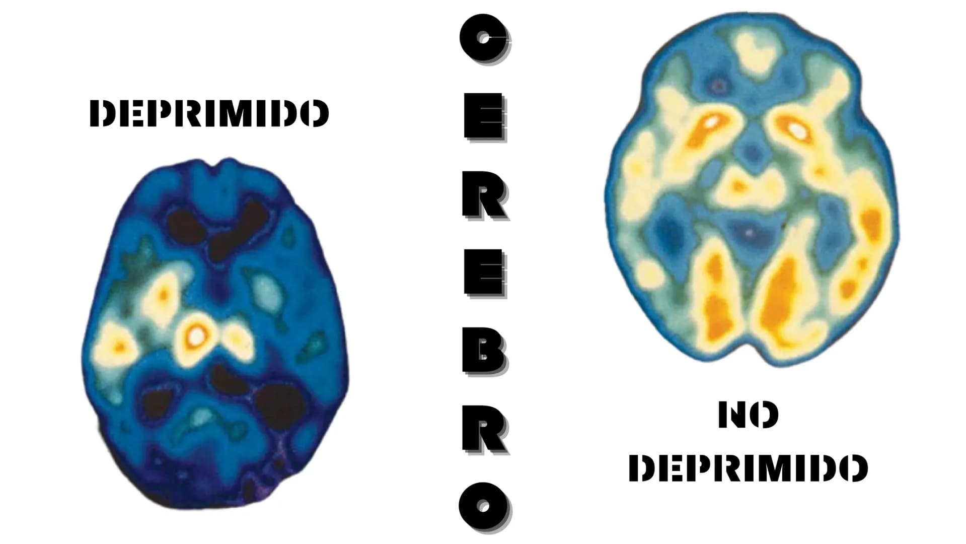 DEPRESIÓN ÍNDICE
05 ¿Qué es?
09 Factores de Riesgo
06 Tipologías
10 Desarrollo
07 Tipos
II Enfermedades
Relacionadas
08 Síntomas
12