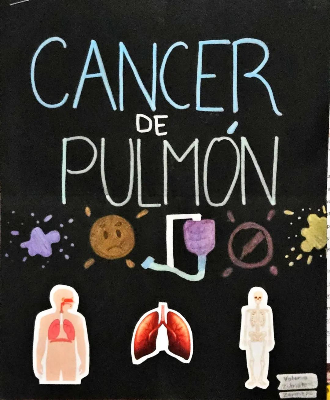# CANCER
## DE
# PULMÓN
Valeria
Zubieta
Zamora PC # CANCER DE PULMON
@¿QUE ES?
El cáncer de pulmón es un cancer que se
forma en los tejido