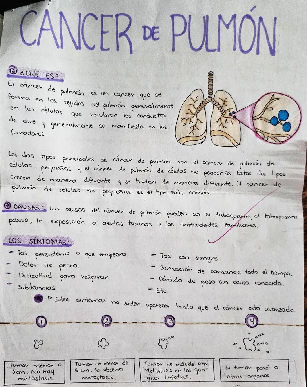 # CANCER
## DE
# PULMÓN
Valeria
Zubieta
Zamora PC # CANCER DE PULMON
@¿QUE ES?
El cáncer de pulmón es un cancer que se
forma en los tejido