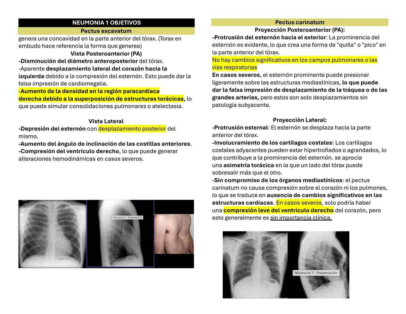 NEUMONIA 1 OBJETIVOS
Pectus excavatum
genera una concavidad en la parte anterior del tórax. (Torax en
embudo hace referencia la forma que ge