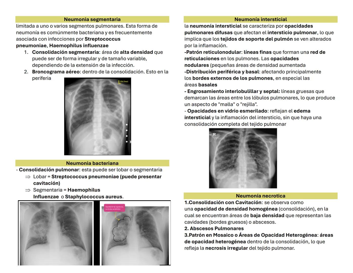 NEUMONIA 1 OBJETIVOS
Pectus excavatum
genera una concavidad en la parte anterior del tórax. (Torax en
embudo hace referencia la forma que ge