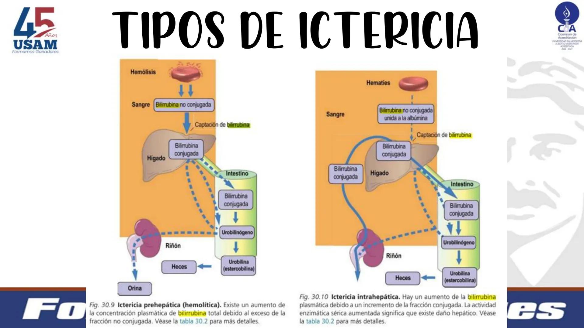 # Metabolismo de la bilirrubina
Dra. Vanessa Iglesias De vez en cuando,
obsérvate con objetividad.
Ni todo lo que piensas es
cierto, ni tod