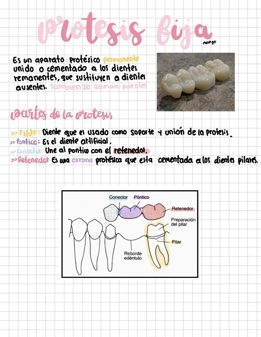 COMPOSITION BOOK
protesis dental
Biza
by: narajo # protesis bija
Es un aparato protésico permanente
unido o cementado a los dientes
remanen