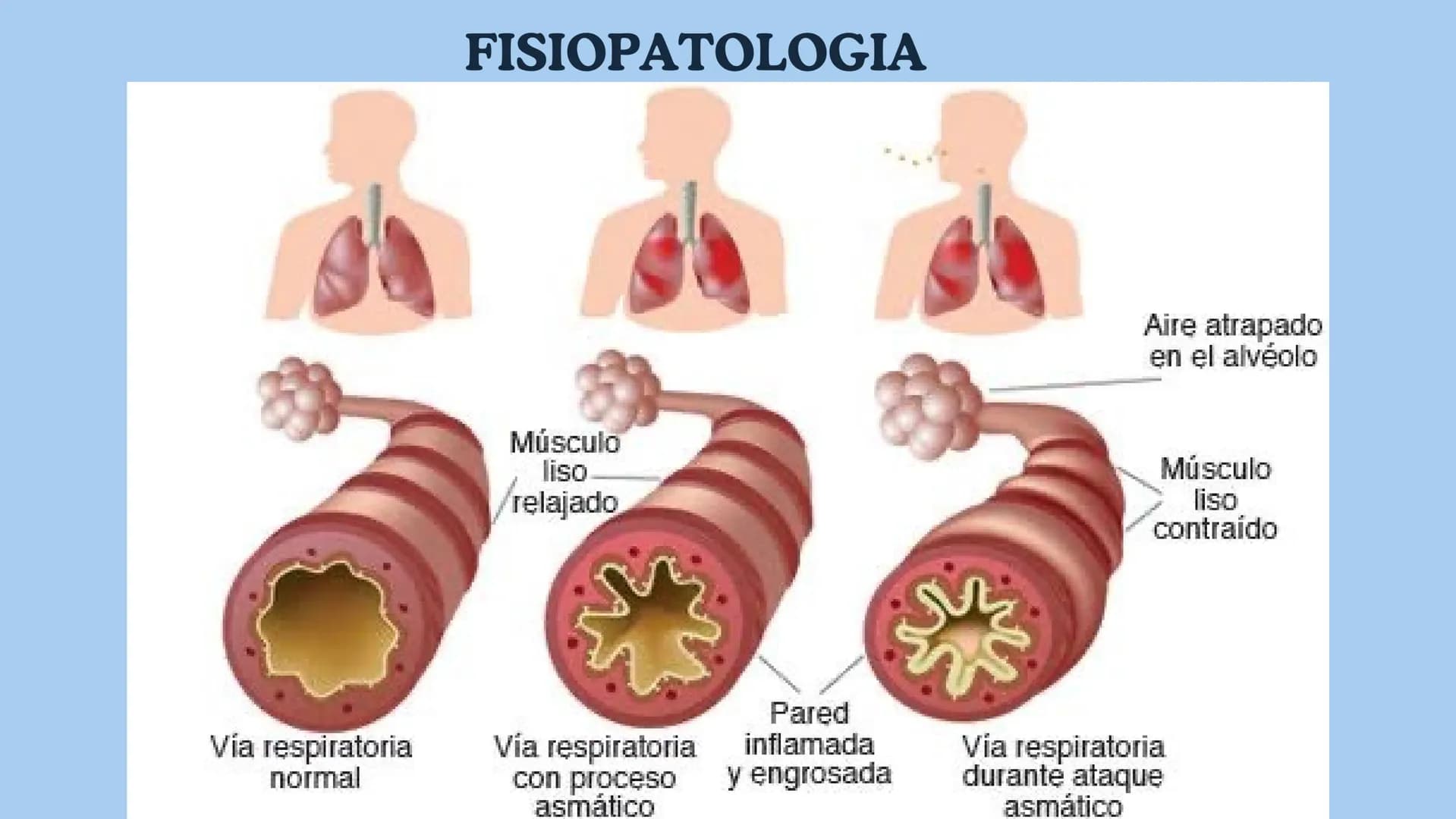 ASMA
NEUMOLOGÍA
Dra. Rocío Durán Las enfermedades
respiratorias son un desafío
global; conocerlas es clave
para prevenir y tratar
Alba Cast