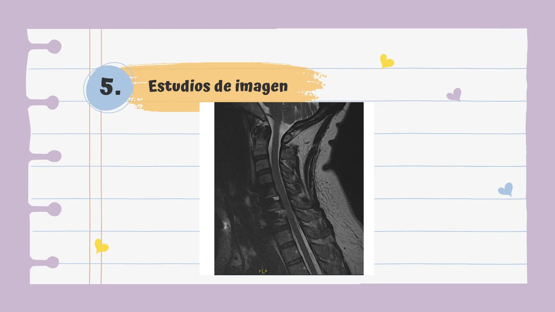 # Introducción
Es una lesión del disco intervertebral, donde el núcleo pulposo al prolapsarse a través del anillo, fibroso, produce un cuadr